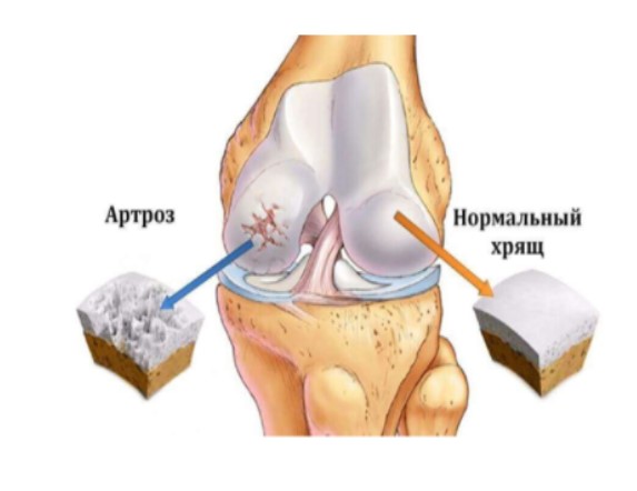 Лечение боли в коленях в центре «Меднеан»