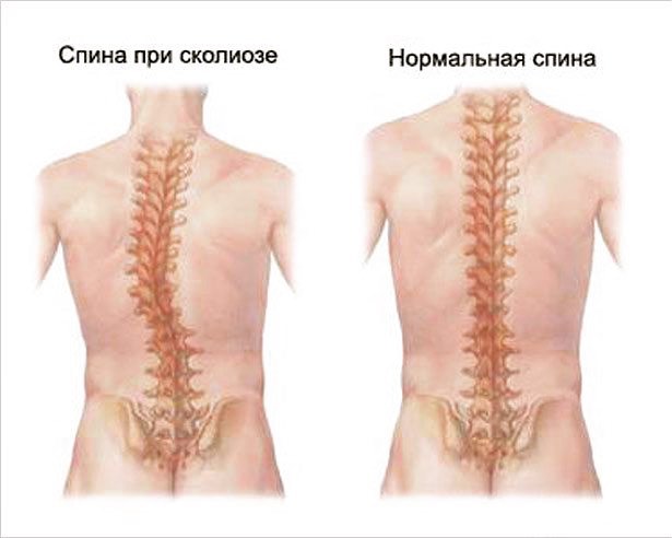 Massazh Pri Skolioze Lechenie Iskrivleniya Pozvonochnika